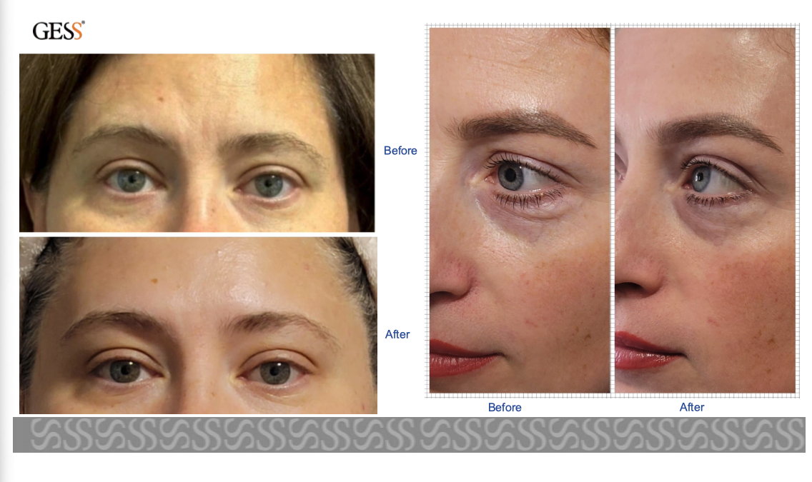 FaceActive by GESS
